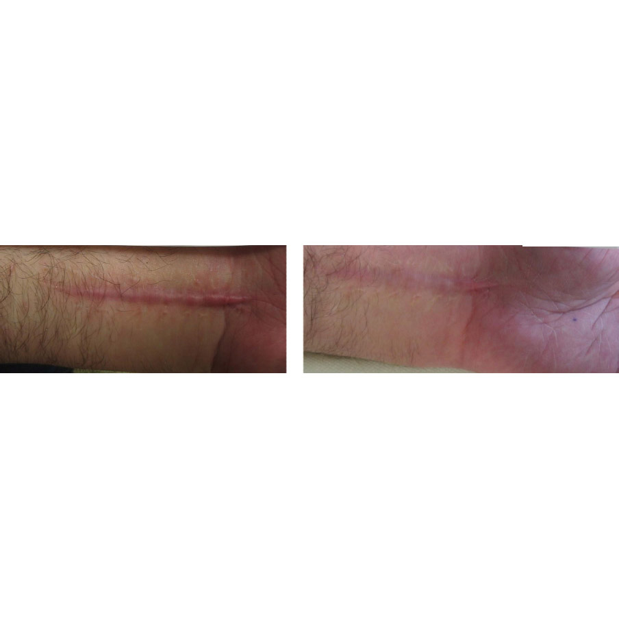 Before and after Softwave wound