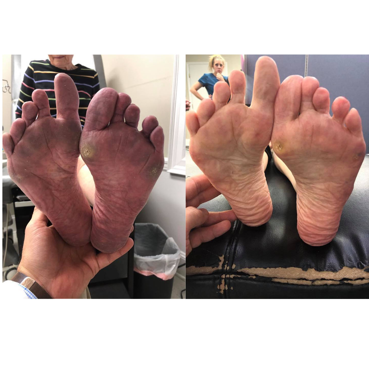 Before after images of feet with SoftWave