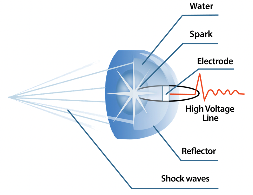 Softwave shockwave starts w spark