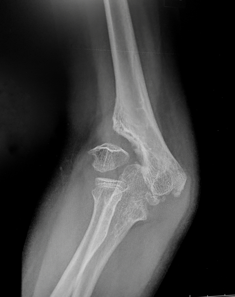 xray showing non union lateral fracture