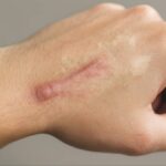 Regenerative Skin Treatment for Burns, Scars, and Wounds
