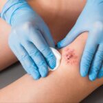 Provider’s Guide to Shockwave Therapy for Wound Care Provider’s Guide to Shockwave Therapy for Wound Care